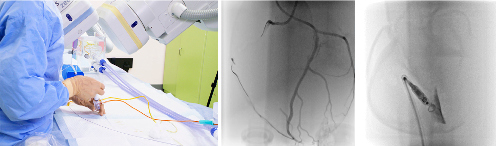 X線透視下での心臓カテーテル治療シミュレーション